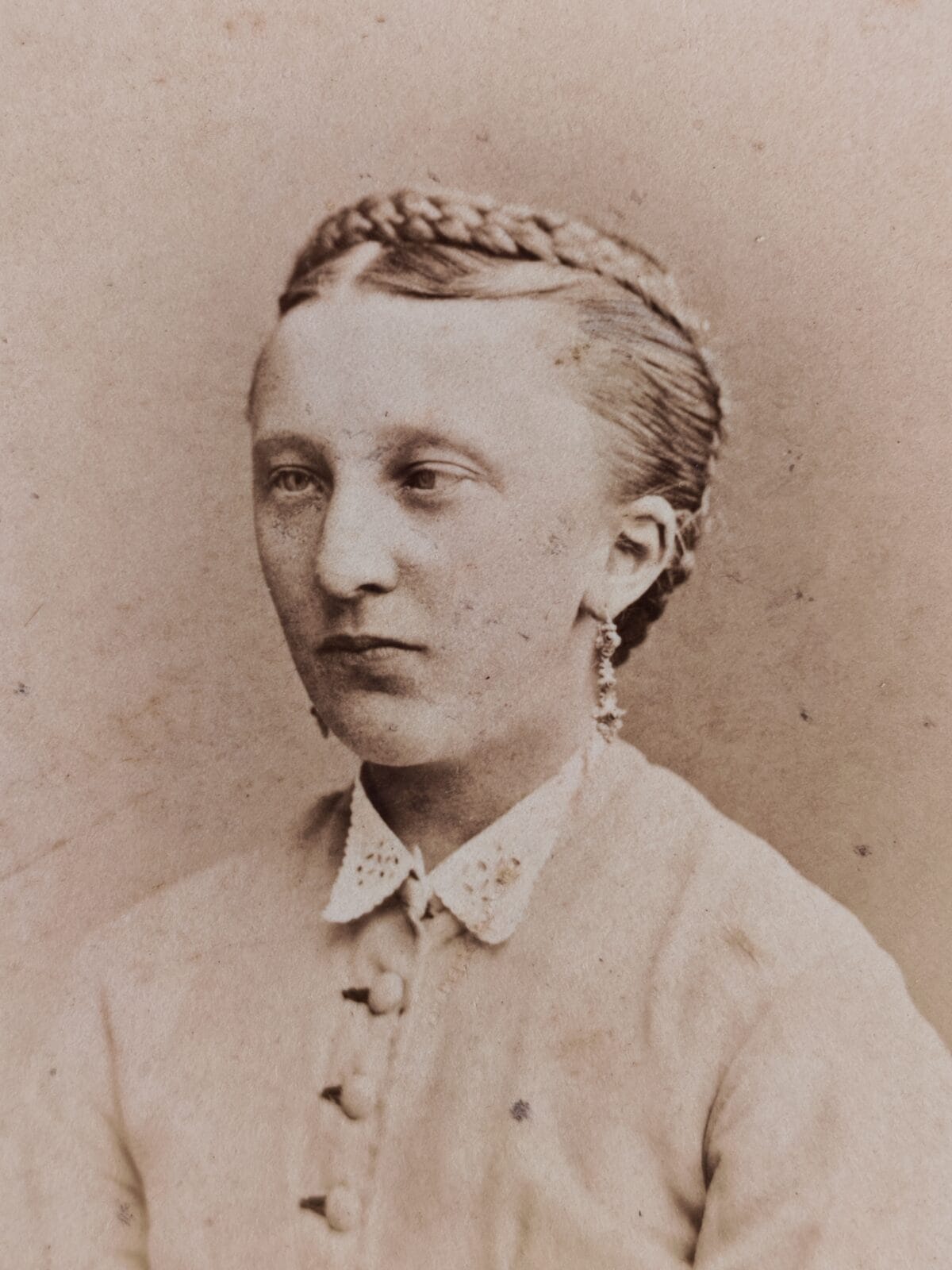, Strabismus
